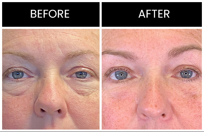 Atlanta Eyelid Surgery Results